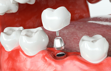 Single Tooth Implants - Pedro Arteche