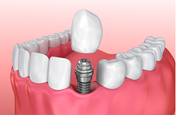 What are Dental Implants? - Pedro Arteche